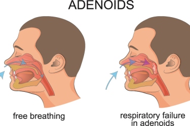 best hospital for ademoids surgery in purnia, best doctor for adenoids treatment in purnia, cost of adenotonsillectomy surgery in purnia