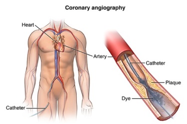 coronary angiography in purnia, angiography of heart in purnia