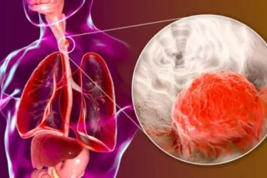 best hospital for treatment of food pipe cancer, best doctor for esophageal cancer surgery, cost of treatment of esophagus or cancer of food pipe, APG Hospital mohali punjab india