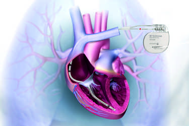 ICD Device Implant, Heart Failure Treatment, Cost of ICD in Purnia, APG Hospital, Purnia, Bihar